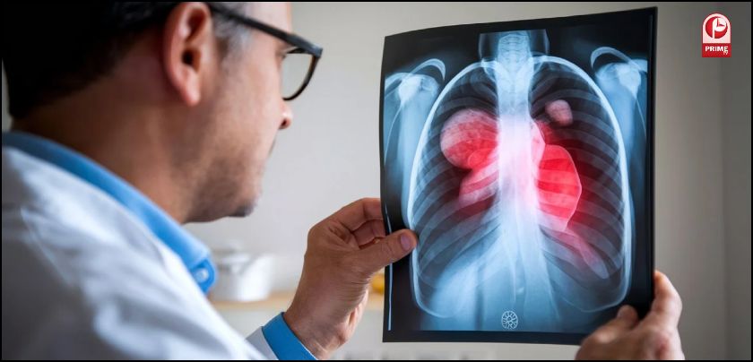 Why are non-smokers getting lung cancer?