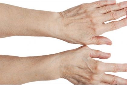 Spider Veins Symptoms