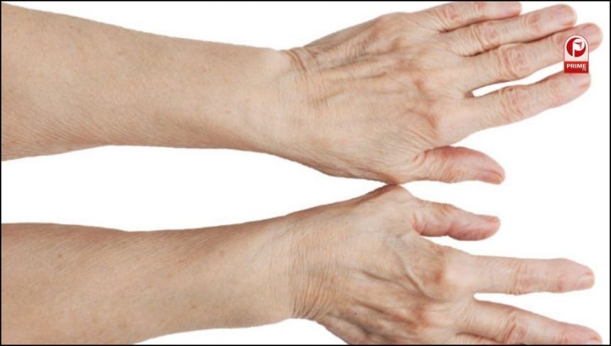 Spider Veins Symptoms