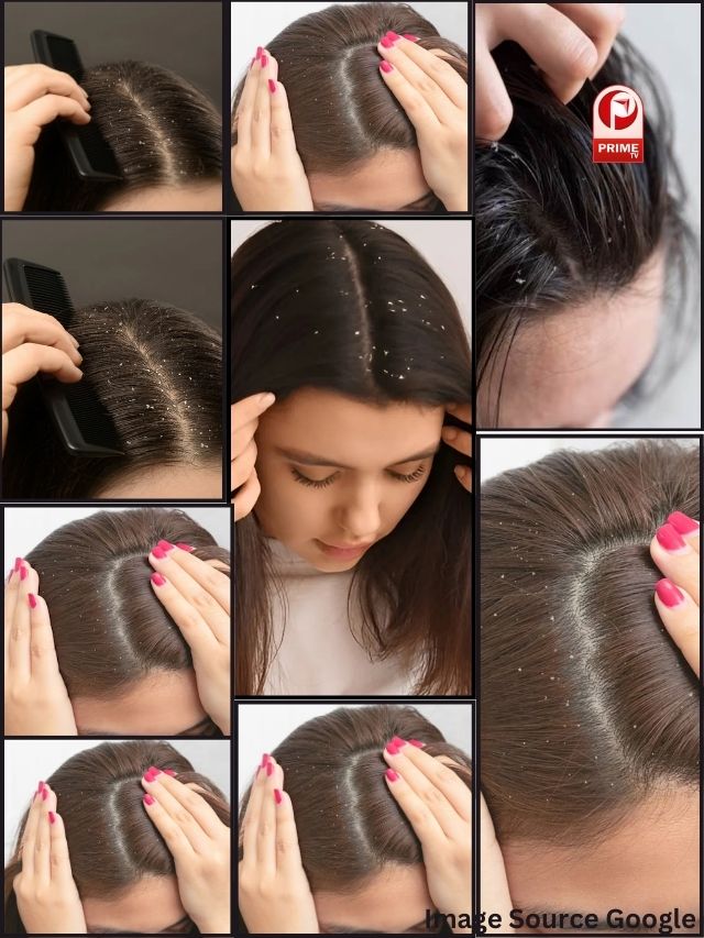 डैंड्रफ की आफत